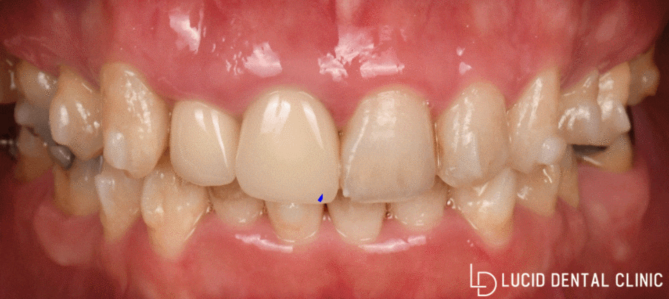연예인 치아처럼 바뀌는 논현동 치과 최소삭제 라미네이트 시술 후기 관련 이미지 1