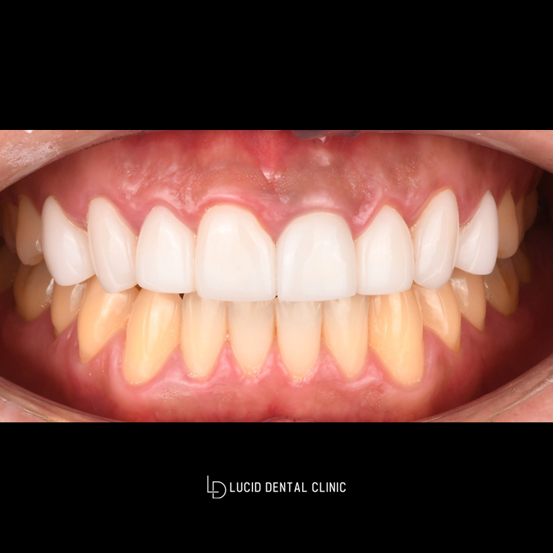 Laminates Retreatment: A Case That Changed from Unnatural to Natural image 1