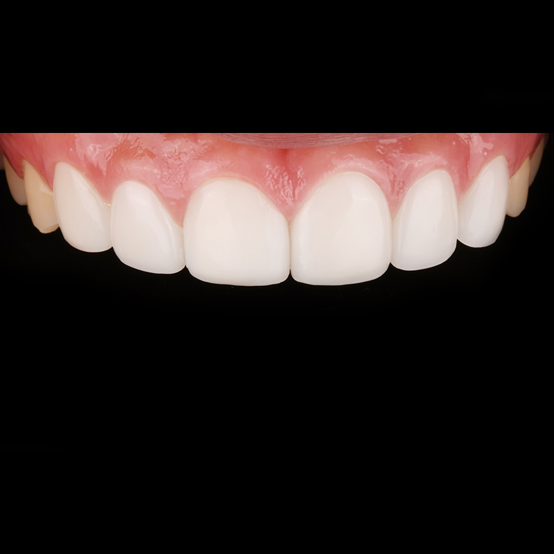 If you want to improve gapped and chipped front teeth, consider Lucinate image 2