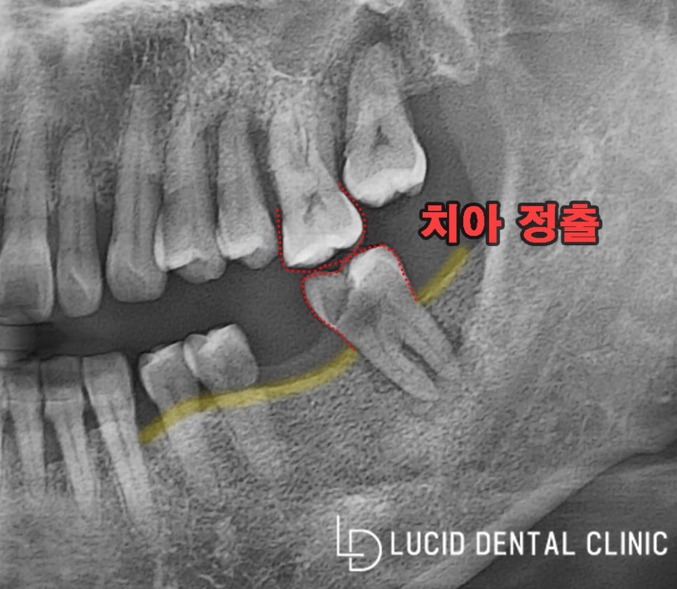 "정기 검진이 필요한 이유?" 역삼동 치과 임플란트 후기 및 수술 후 주의 사항 관련 이미지 2