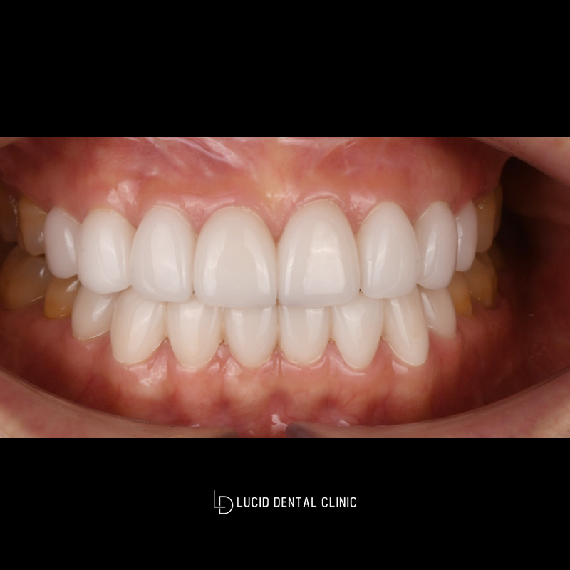 Worried About Yellow Teeth? A Case Improved with Lucinate image 2