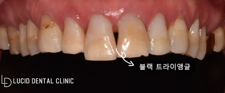 강남역 치과 에서 앞니 치아 부분 라미네이트 로 블랙 트라이앵글 개선과 잃어버린 자신감을 되찾아드렸습니다! 관련 이미지 2