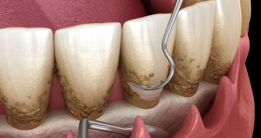 치주염으로 비어보이는 치아, 강남역 치과 에서 루시네이트 시술 후기 관련 이미지 1