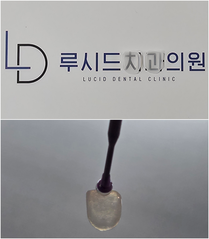 삐둘어지고 착색된 앞니, 라미네이트 시술로 하루만에 바뀔 수 있습니다. - 서초동 치과 루시네이트 추천 관련 이미지 4