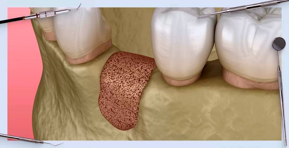 서초동 치과 임플란트 뼈이식 과정부터 재료, 주의 사항 한 번에 알려드리겠습니다! 관련 이미지 2