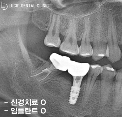 어금니 통증 알고 보니 염증 질환? 신논현역 치과 디지털 임플란트 로 되찾은 치아 기능 관련 이미지 5