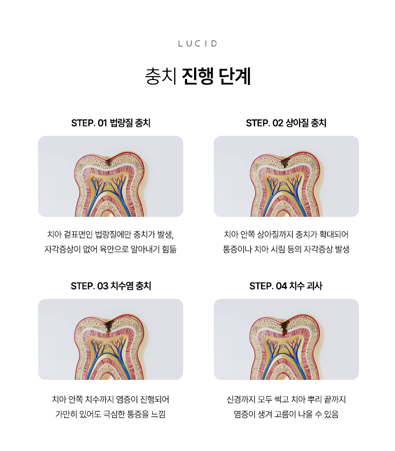 Yeongdeungpo Station Dentist: From the Causes of Cavities to Stage-by-Stage Symptoms image 5