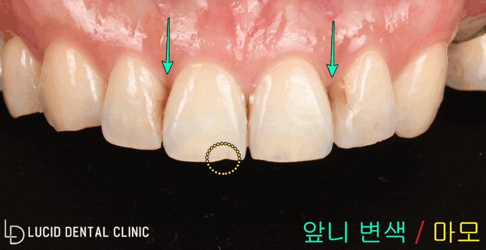 역삼동 치과 - 앞니 치아 마모 및 변색, 원데이 라미네이트 시술로 빠르고 간편하게! 관련 이미지 1