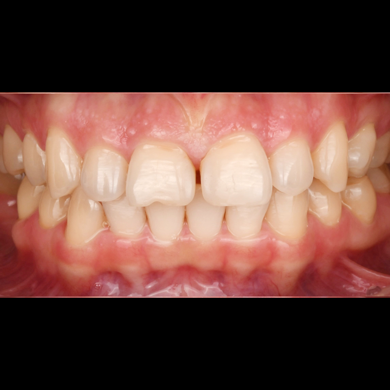Improvement Case for Gapped Front Teeth with Lusinate Instead of Orthodontics image 1