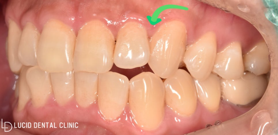선정릉역 치과 에서 불규칙한 치열까지 루시네이트(라미네이트)로 바꿀 수 있다? 관련 이미지 1
