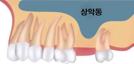 사라진 치아 기능, 논현역 치과 디지털 분석 어금니 임플란트 수술 로 되찾을 수 있습니다. 관련 이미지 3