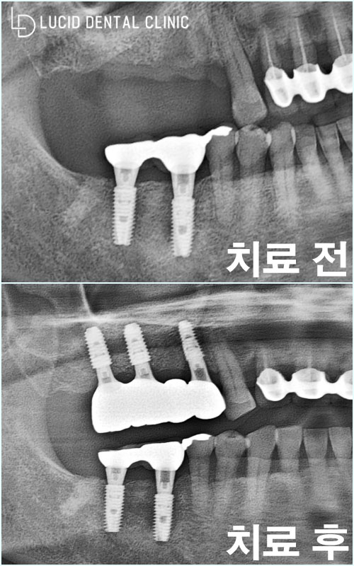 사라진 치아 기능, 논현역 치과 디지털 분석 어금니 임플란트 수술 로 되찾을 수 있습니다. 관련 이미지 6