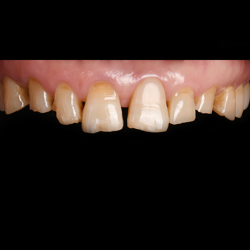 A Case of Naturally Improving Gapped Teeth with Lucinate at Yeoksam Dental Clinic image 1