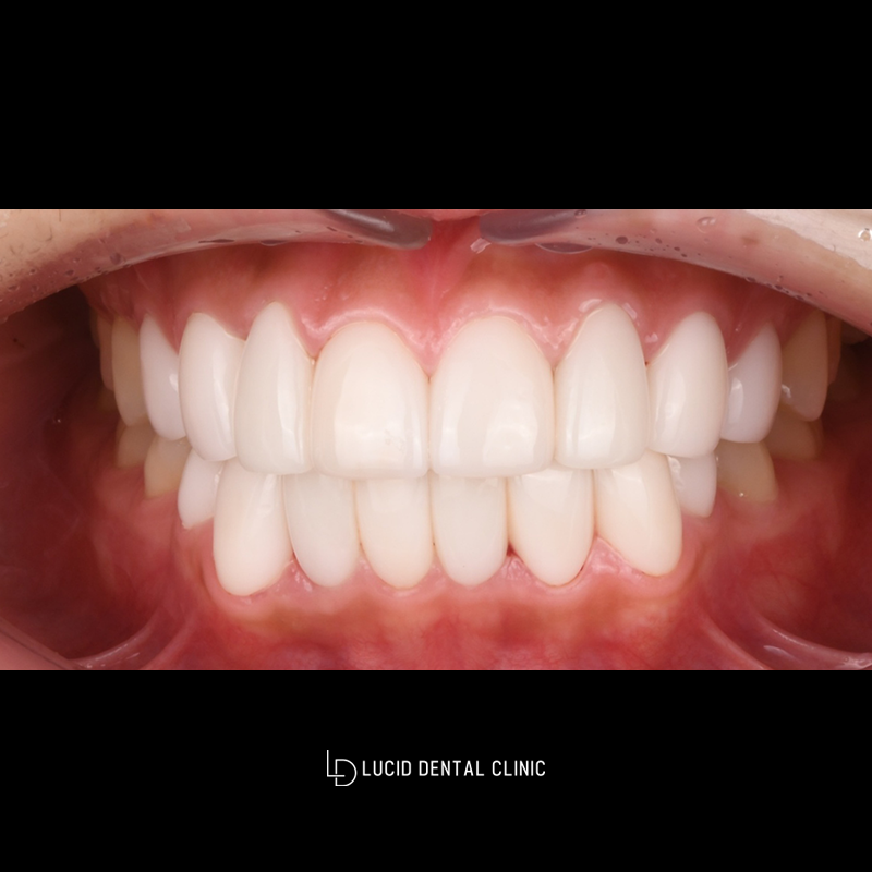 Improving Crooked Front Teeth and Uneven Tooth Alignment with Lucinate image 2