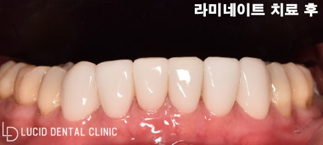 까맣게 변색된 치아, 강남역 치과 에서 라미네이트 로 해결 가능합니다! 관련 이미지 7