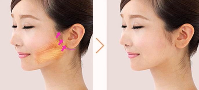 목동리프팅 성형외과 전문의가 추천하는 솔루션 3가지 관련 이미지 4