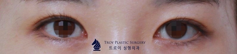 오목교쌍수 잘 하는 곳에서 알려주는 절개, 매몰 선택법 관련 이미지 2