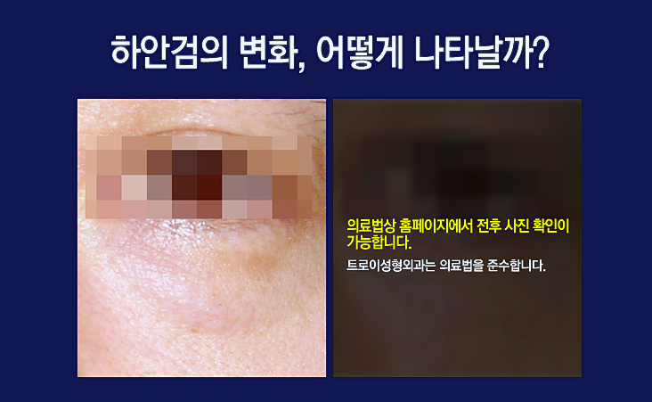 강서구 눈처짐수술 효과 제대로 보는 방법! 관련 이미지 2