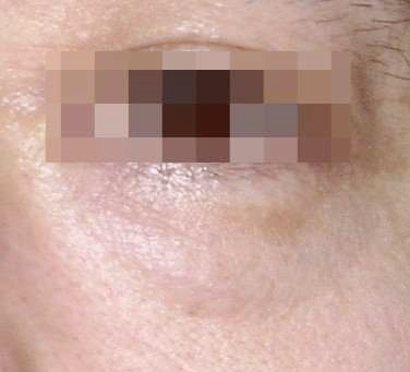 Recommended Types of Mokdong Middle-Aged Eye Surgery: 3 Surgery Options for Drooping Eyes image 3
