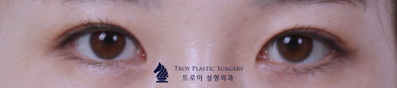 양천구성형외과 가로 눈 길이 짧을 때 앞트임? 뒤트임? 관련 이미지 1