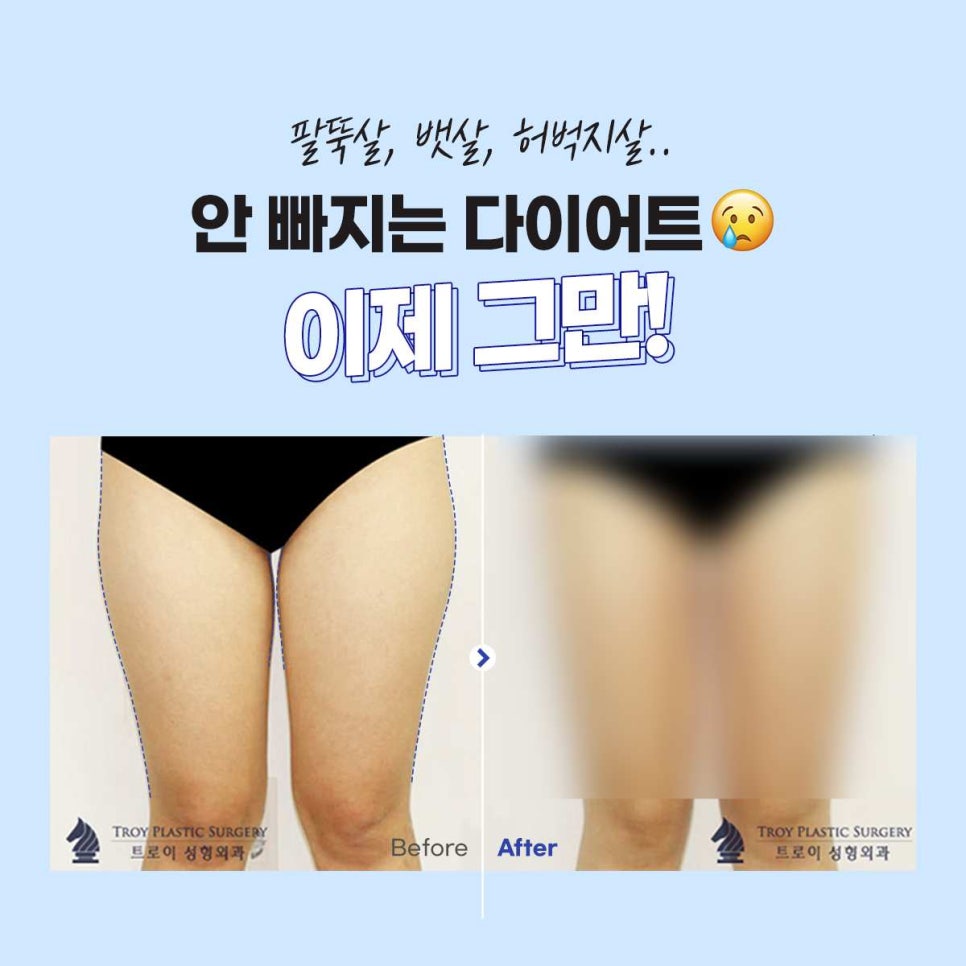 목동 트로이성형외과 지방분해주사 프로그램 인기 많은 이유 관련 이미지 5