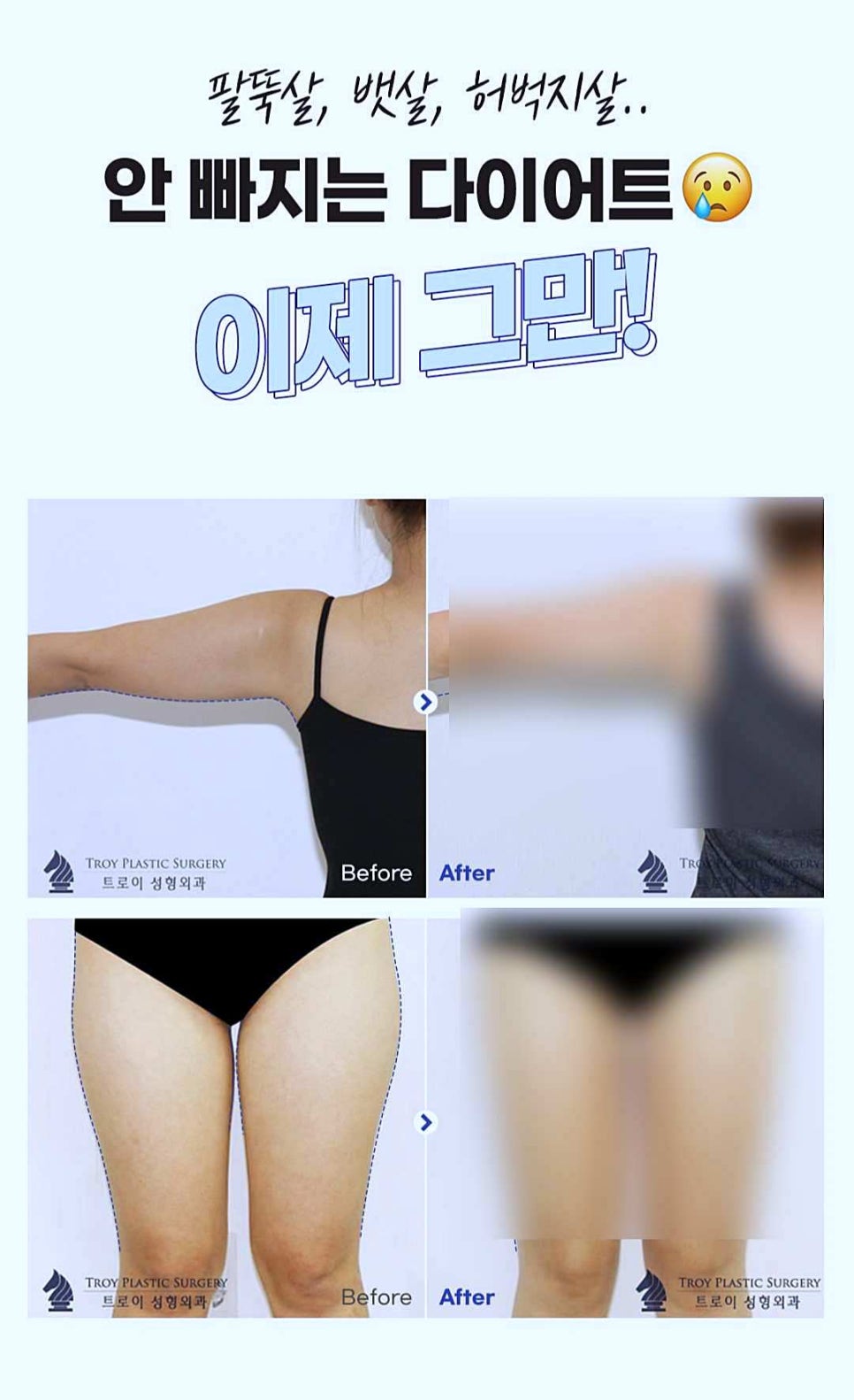 목동지방분해주사 트로이를 찾는 이유 관련 이미지 5