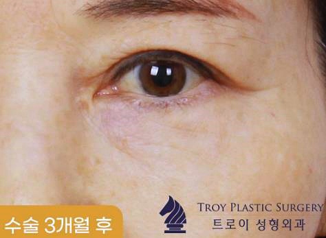 오목교눈성형 가격 겨울 한정 이벤트 모음 (트임성형/눈매교정/눈썹밑거상술/상안검/하안검) 관련 이미지 3