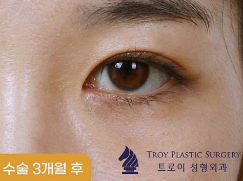 오목교눈성형 가격 겨울 한정 이벤트 모음 (트임성형/눈매교정/눈썹밑거상술/상안검/하안검) 관련 이미지 1
