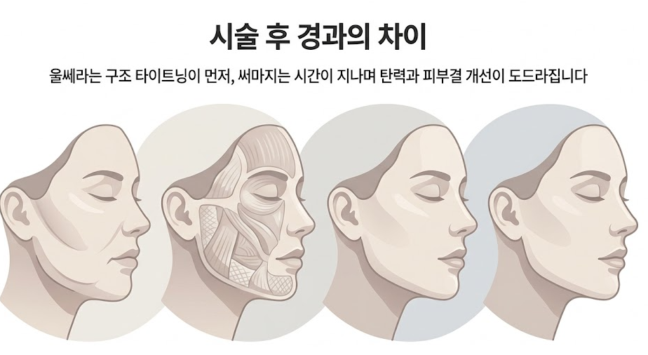 울쎄라 써마지 차이점, 선택 기준을 먼저 확인하세요 관련 이미지 6