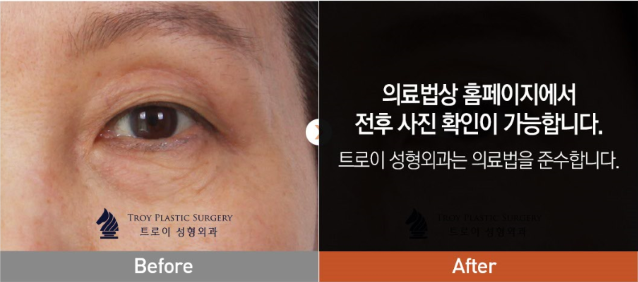 강서구 눈처짐수술 효과 제대로 보는 방법! 관련 이미지 4