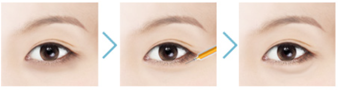 Mokdong Station Fillers: What’s the Most Effective Choice by Facial Area? image 3