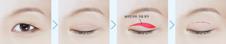 목동상안검 중년 눈꺼풀 처짐 흉터 없이 개선했어요 관련 이미지 1
