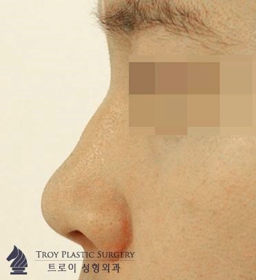 목동필러, 부작용을 예방하는 방법은? 관련 이미지 4