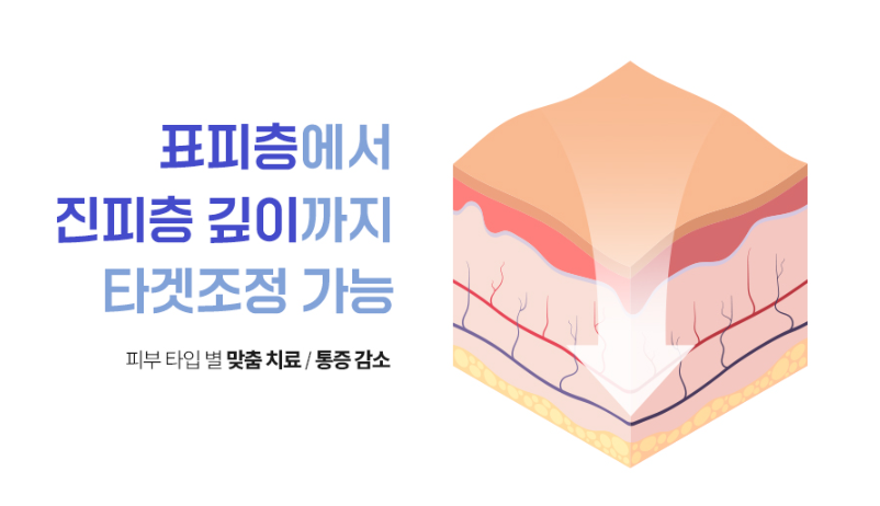 목동문신제거 안전하게 제거하는 스타워커 장비란? 관련 이미지 5