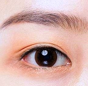 김포쌍꺼풀수술 돌출눈/함몰눈 이렇게 해야 성공합니다 관련 이미지 3