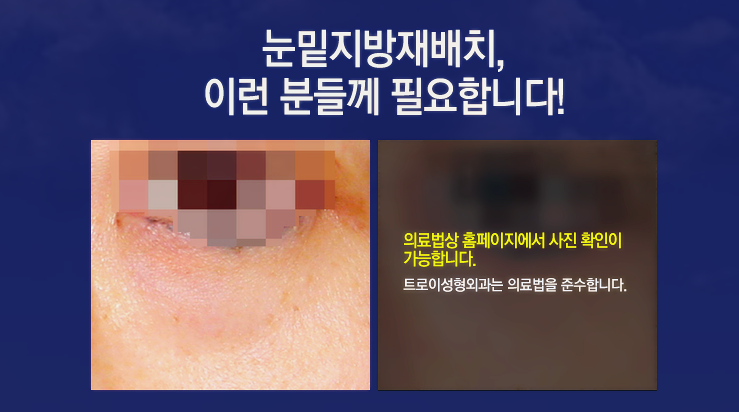 목동 눈밑지방재배치 덕분에 다크서클 볼록살 고민 해결했어요 관련 이미지 2