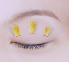 목동쌍꺼풀 수술 실패하지 않는 방법 관련 이미지 3