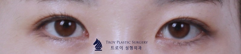 트로이성형외과 김포에서도 방문하는 이유 관련 이미지 5