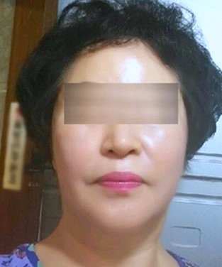 강서구리프팅, 피부 유형별 추천 시수술 3가지 관련 이미지 2