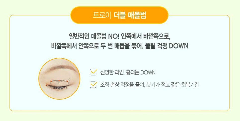 영등포쌍수 매몰vs절개 나에게 적합한 수술 방법은? 관련 이미지 1