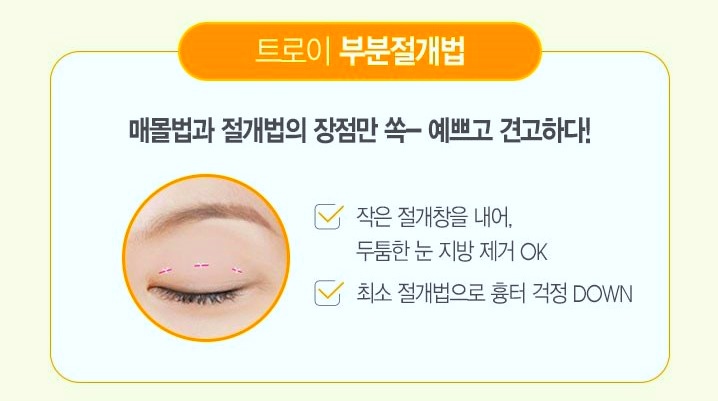 영등포쌍수 매몰법vs절개법 나에게 어울리는 수술 방법은 뭘까 관련 이미지 3