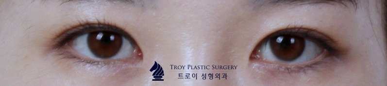 강서구성형외과 잘하는 곳? 모르면 손해입니다 관련 이미지 4