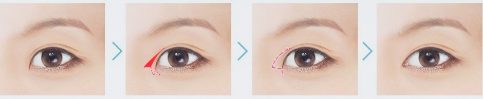 목동트임성형, 나는 앞트임? 뒤트임? 뭐가 필요할까 관련 이미지 1
