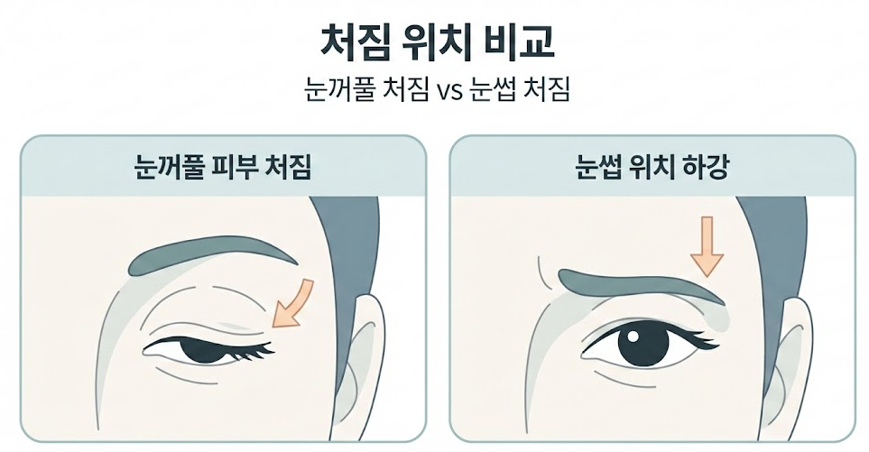 목동 처진눈, 쌍꺼풀 VS 상안검 VS 눈썹하거상 무엇이 기준일까요? 관련 이미지 2