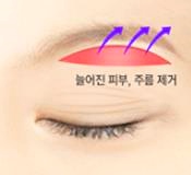 목동성형외과 추천 중년눈성형 3가지 관련 이미지 3
