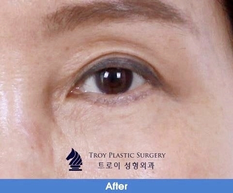 목동성형외과 중년눈성형 잘하는 곳에서 추천하는 수술 4가지 관련 이미지 1