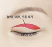 Gimpo Plastic Surgery: Upper Blepharoplasty or Eyebrow Lift? Which Droopy Eye Surgery Is Right for Me? image 1