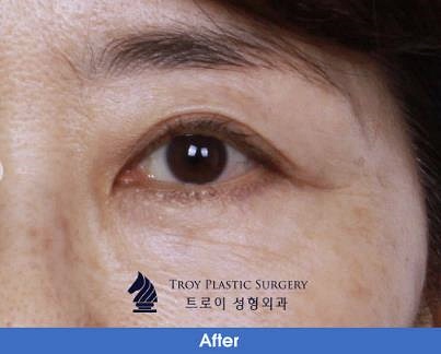 목동중년쌍수 부작용 걱정되시는 분들은 보세요 관련 이미지 1