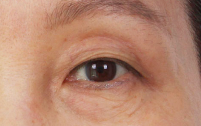 Mokdong Upper Blepharoplasty image 3