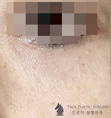 목동성형외과 중년눈성형 잘하는 곳에서 추천하는 수술 4가지 관련 이미지 3